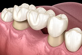 A 3D illustration of a traditional dental bridge