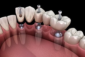 A 3D illustration of an implant bridge