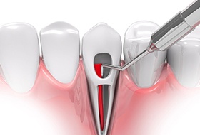 Illustration of a root canal being performed