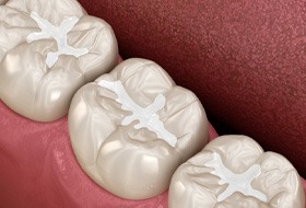 Tooth-colored fillings 