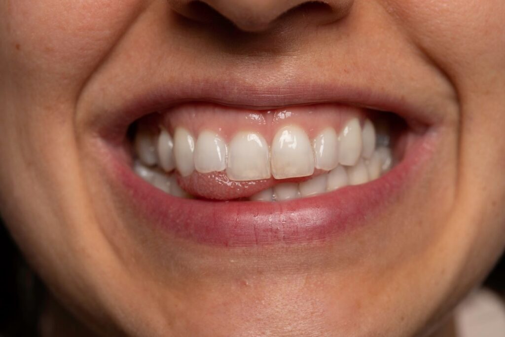 A closeup of a woman's teeth and gums.