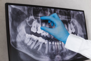 Dentist pointing out a damaged tooth on an X-ray