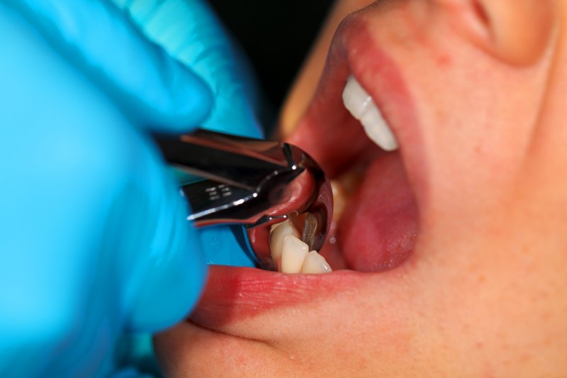 A dentist using dental forceps to extract a tooth